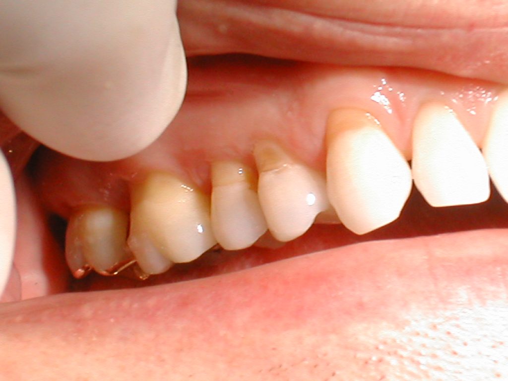 What Is Abrasion In Dental at dorissmattos blog